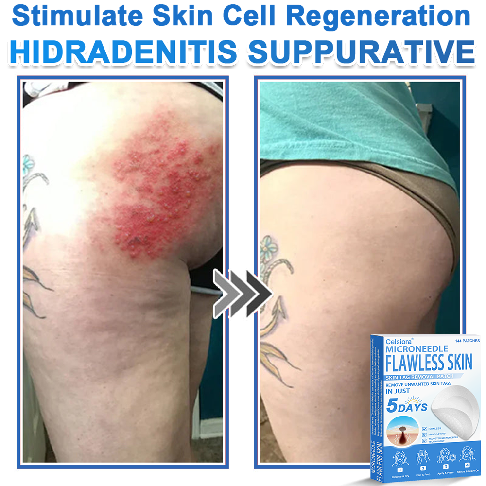 GlowSkin - 2-in-1 Microneedle & Hydrocolloid Star Patch