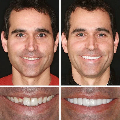 🌎Ends Today: 70% OFF! ⏰Yagoo™ Medical Full Denture with Strong Suctiond🦷Obtain American Dental Association (ADA) Certification