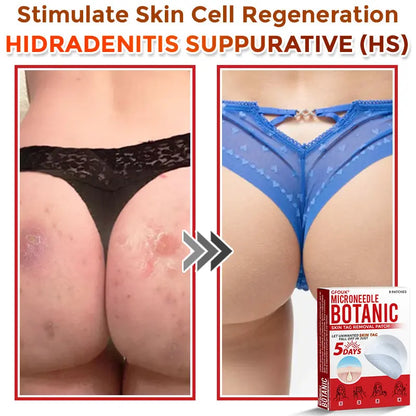 Natrvor –2-in-1 Microneedle Botanical Skin Renewal Patch