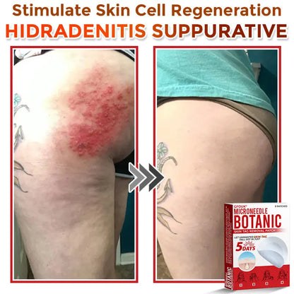 Natrvor –2-in-1 Microneedle Botanical Skin Renewal Patch