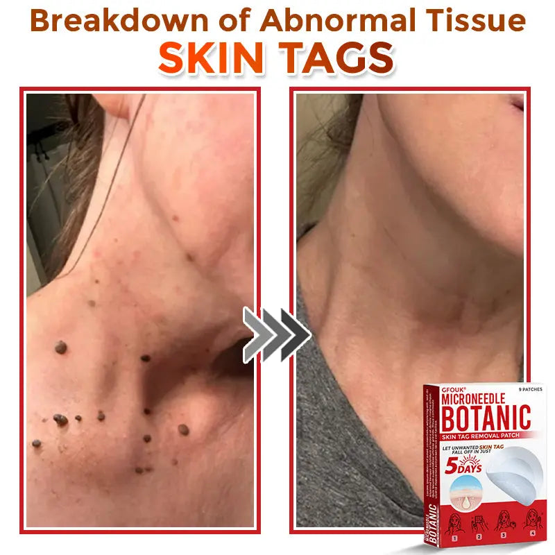 Natrvor –2-in-1 Microneedle Botanical Skin Renewal Patch