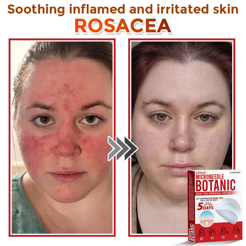 Natrvor –2-in-1 Microneedle Botanical Skin Renewal Patch