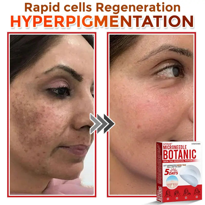 Natrvor –2-in-1 Microneedle Botanical Skin Renewal Patch