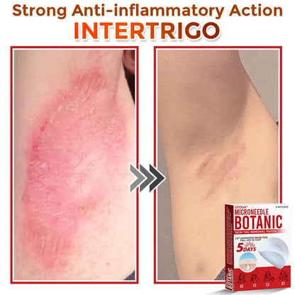 Natrvor –2-in-1 Microneedle Botanical Skin Renewal Patch