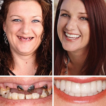 🌎Ends Today: 70% OFF! ⏰Yagoo™ Medical Full Denture with Strong Suctiond🦷Obtain American Dental Association (ADA) Certification